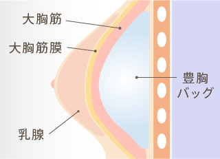 大胸筋下法