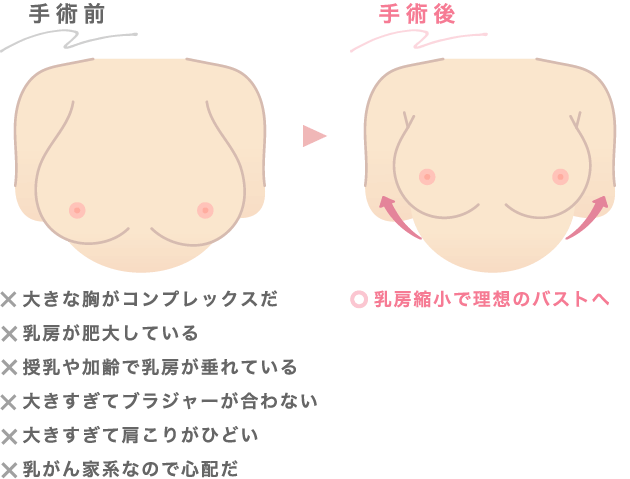 乳房縮小で理想のバストへ