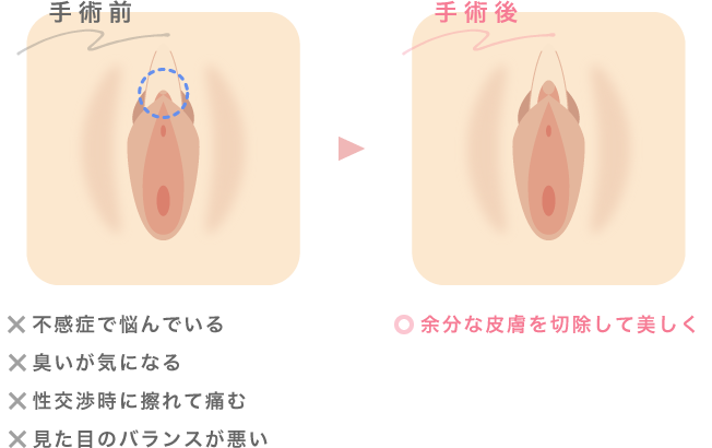 余分な皮膚を切除して美しく