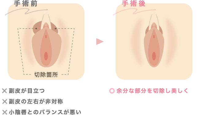 副皮切除で見た目のバランスを整える