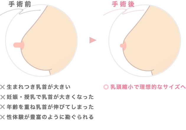 大きな乳頭をご希望のサイズに整える