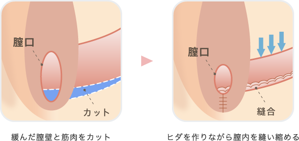 膣縮小手術