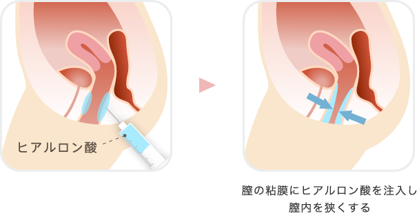 ヒアルロン酸によるプチ膣縮小注射