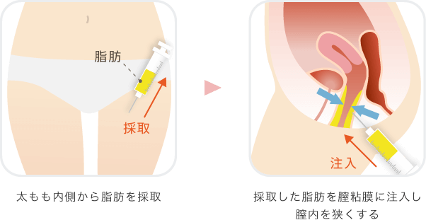 脂肪注入